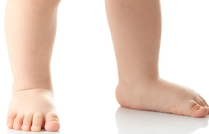 القدم المسطحة عند طفلك