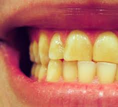 اصفرار الأسنان
