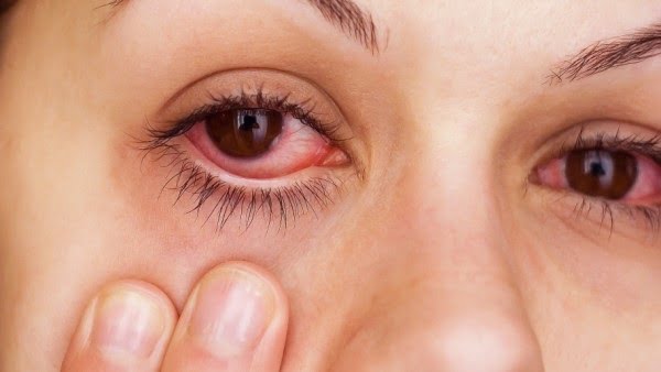 يحدث التهاب العين بسبب إصابة بكتيريا أو فيروس. لذا سوف نسرد عليك في هذا المقال أعراض وأسباب وعلاج التهاب العين. فتابعي معنا السطور التالية.